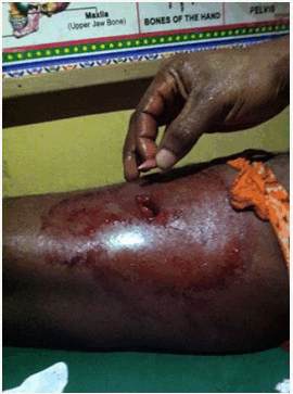 biafra-extraction-of-bullet-from-IPOB-protester in Biafra